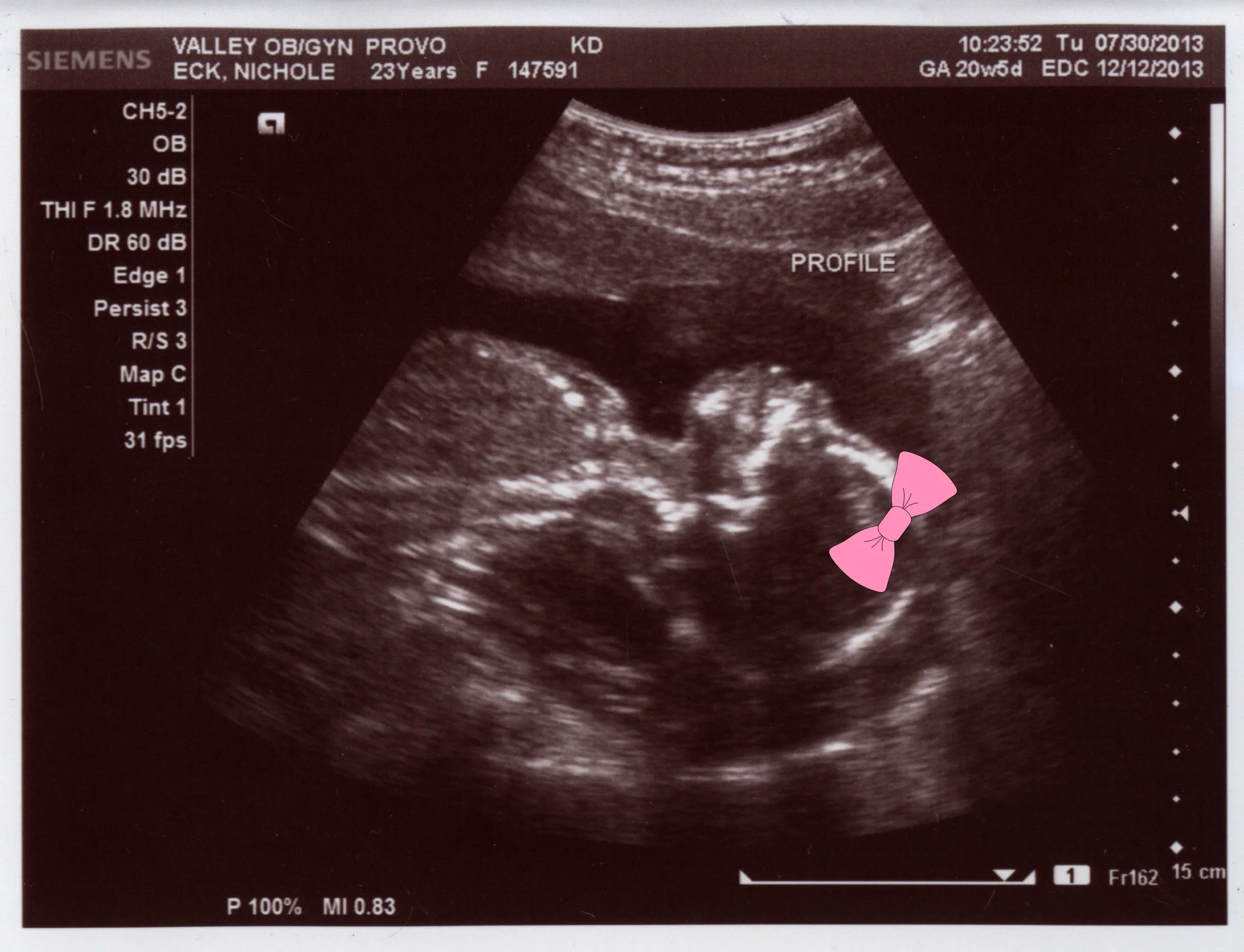 Baby Ecklet Update: It's a Girl!!