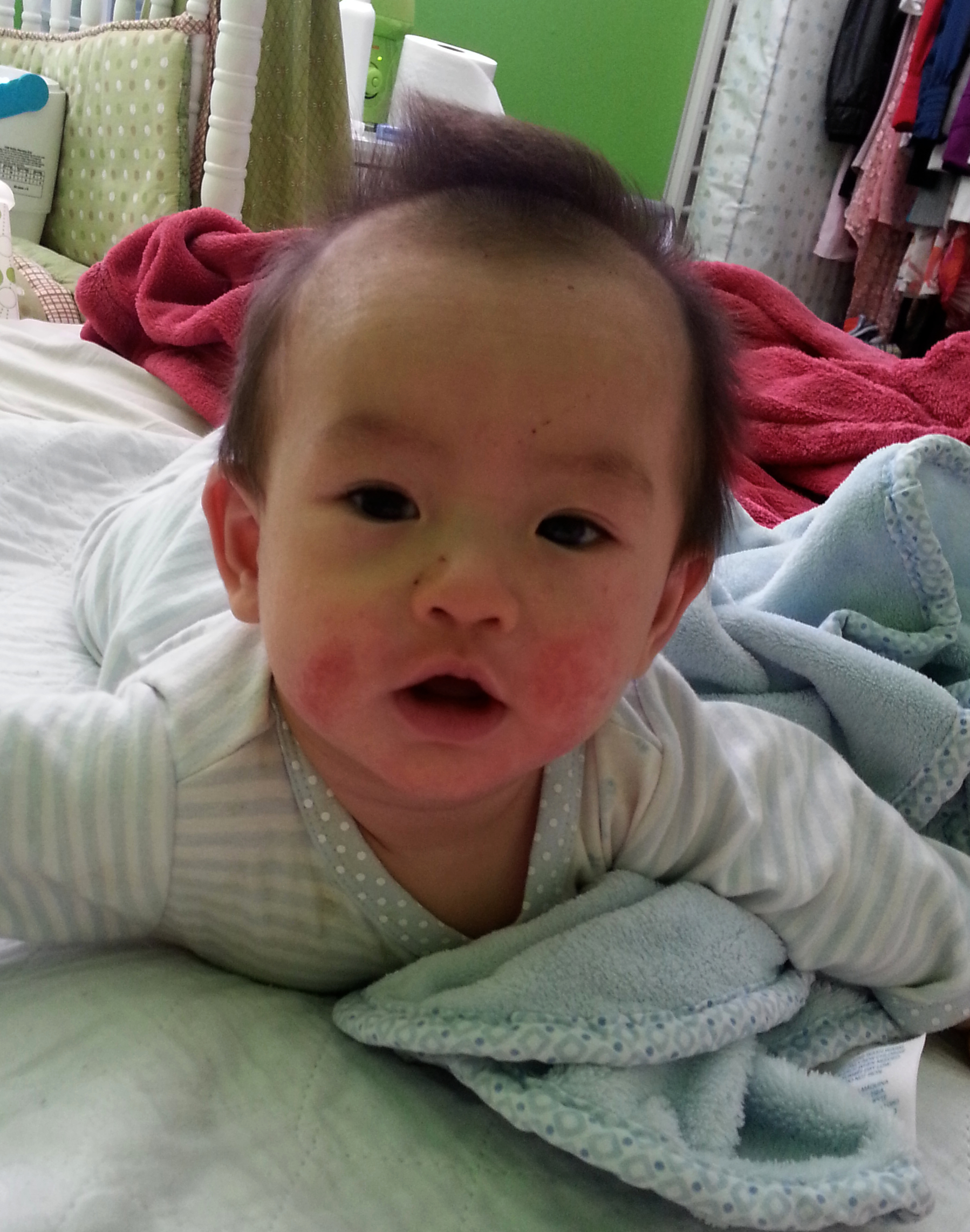 Luke Before Treatment