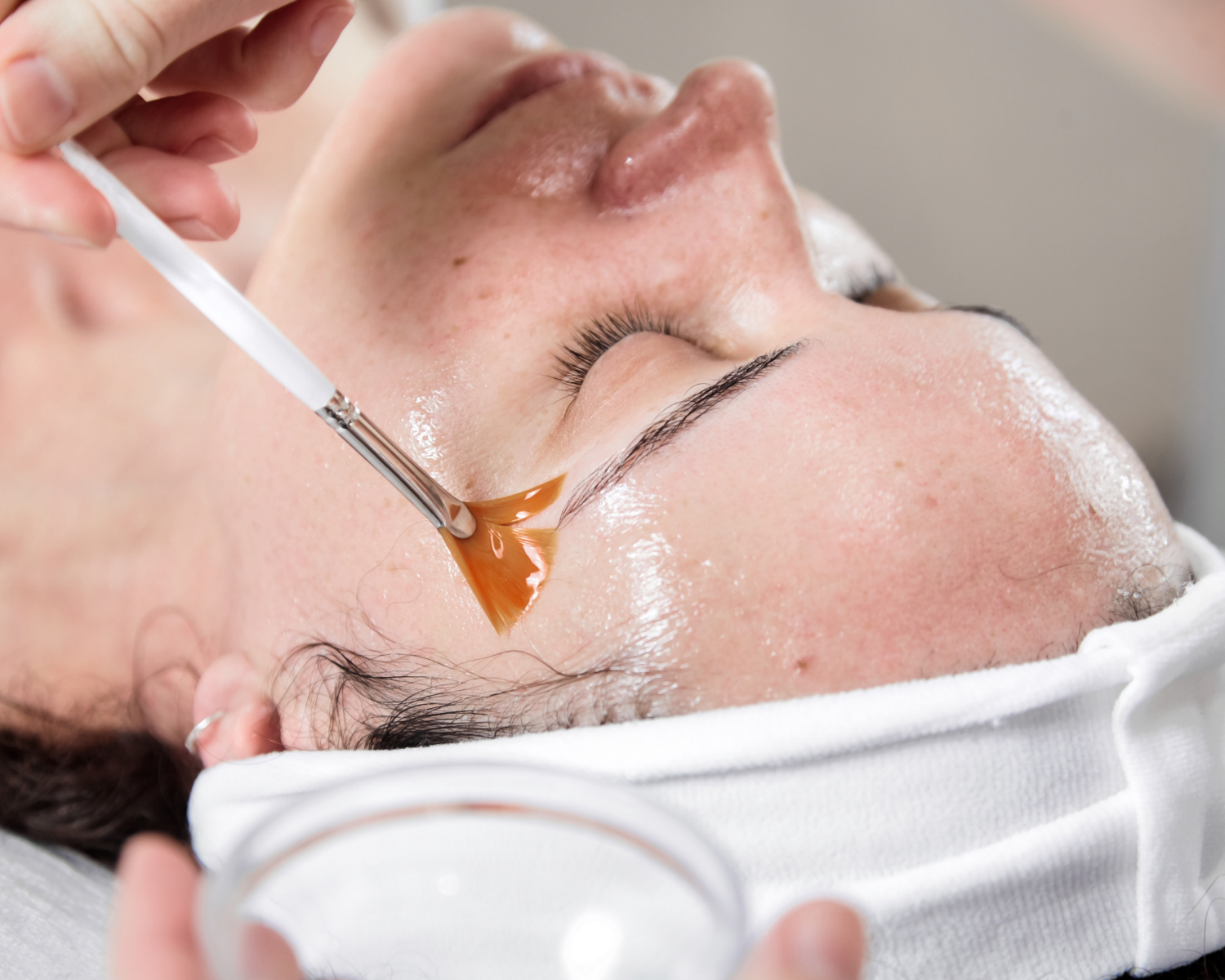 What's the Deal with Chemical Peels?