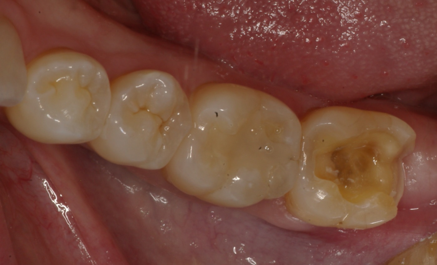Same Day CEREC Inlay