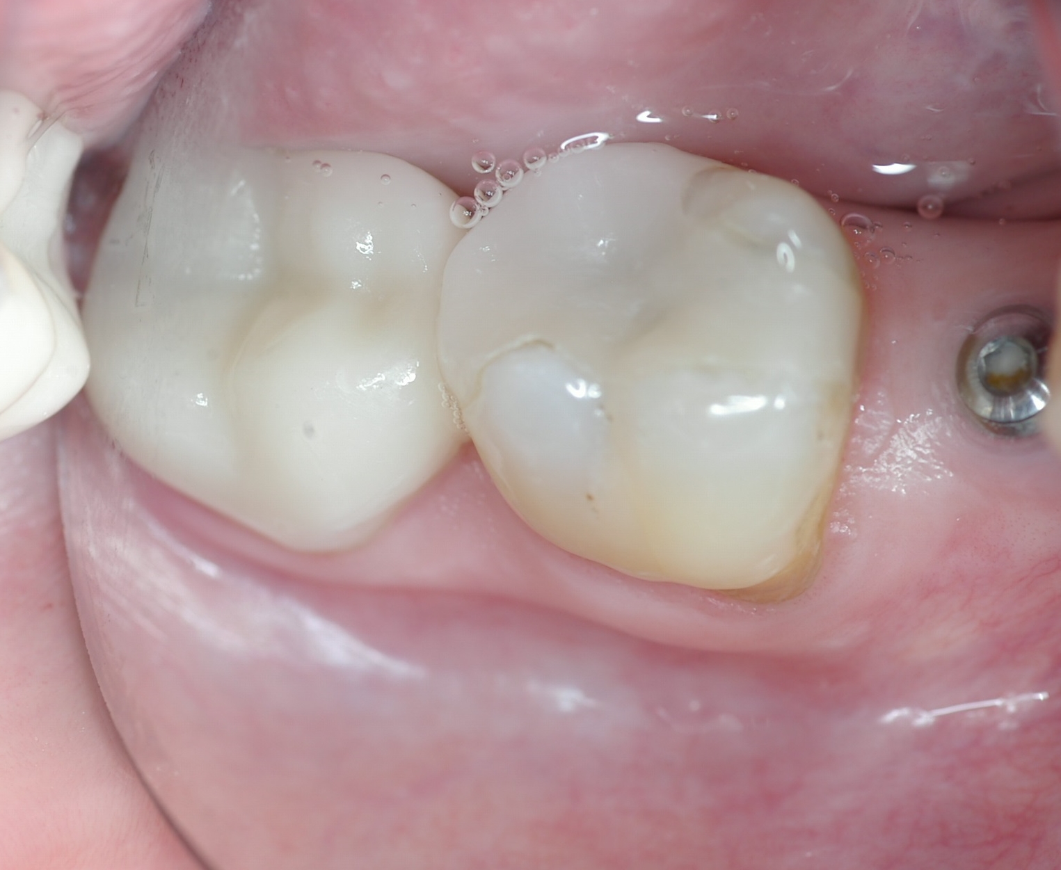 CEREC Onlay