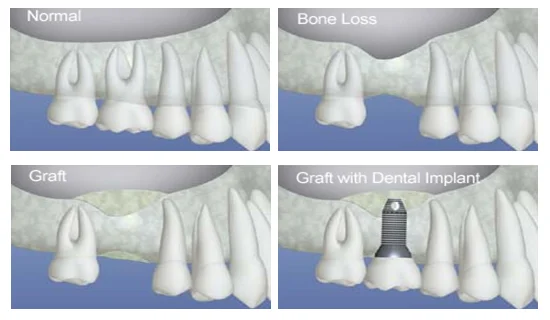 bonegraft2.jpg