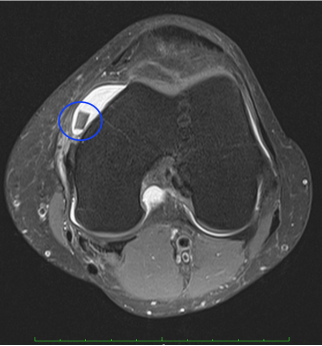 MSCC Knee MRI 2.png