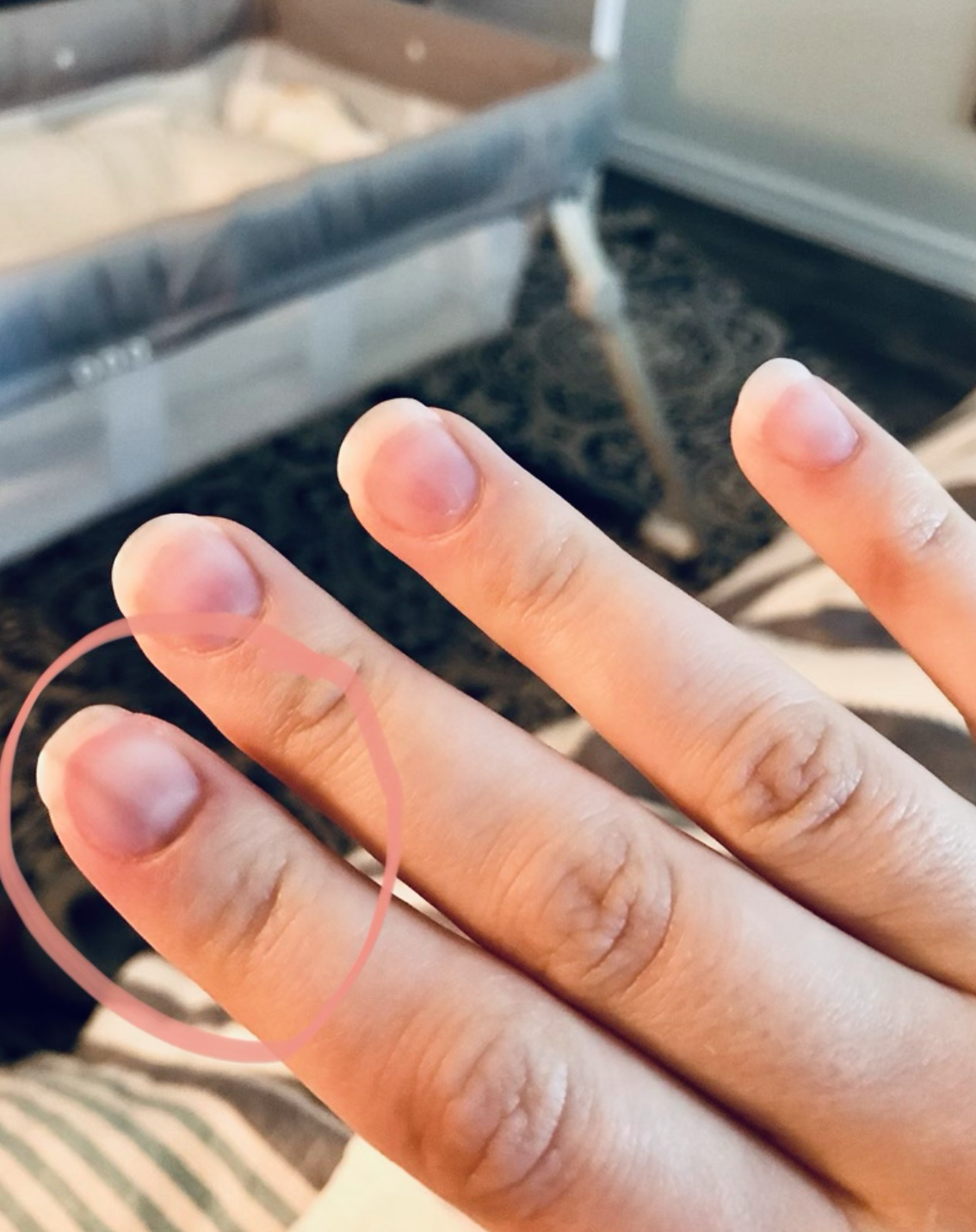 Fingernails changes associated with chemotherapy in breast cancer:  Muehrcke's lines - Chang - 2018 - Clinical Case Reports - Wiley Online  Library