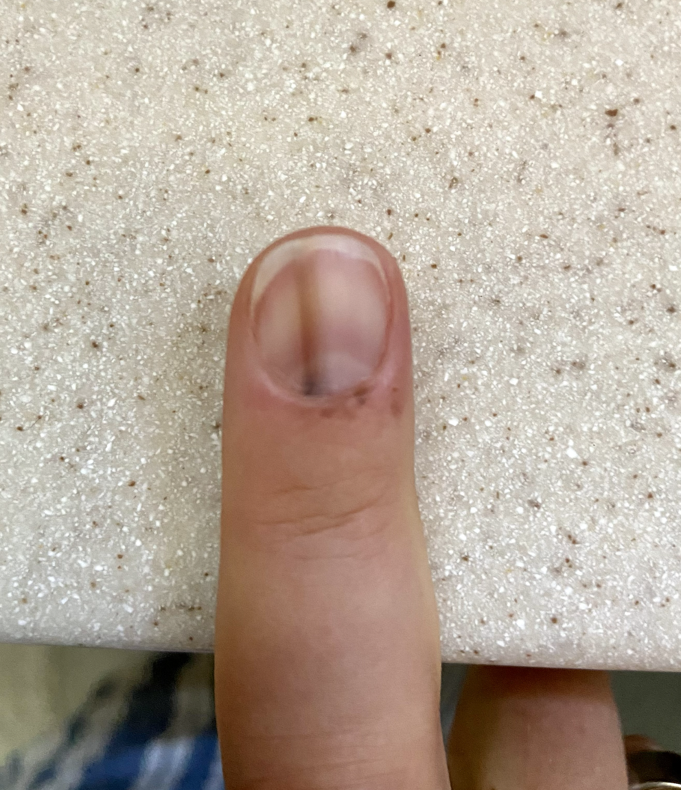 dark line on finger nail cancer｜TikTok Search