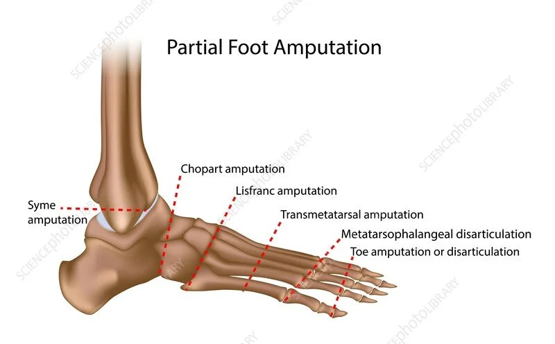 Orthotic Treatment for Toe Amputation at the MTPJ Level