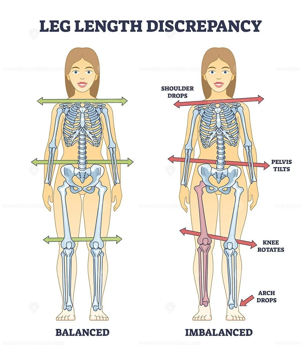 Leg Length discrepancy - General information — Orthotic Expert Witness
