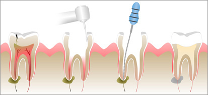 Illustrated is an infected tooth that is restored by a root canal treatment. The infected area within the tooth is cleaned out and then sealed with a special material prior to being restored with a crown . 