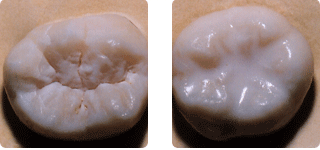 (LEFT) Pictured is an untreated tooth, with deep grooves and pits. (RIGHT) The tooth is treated with a protective sealant.