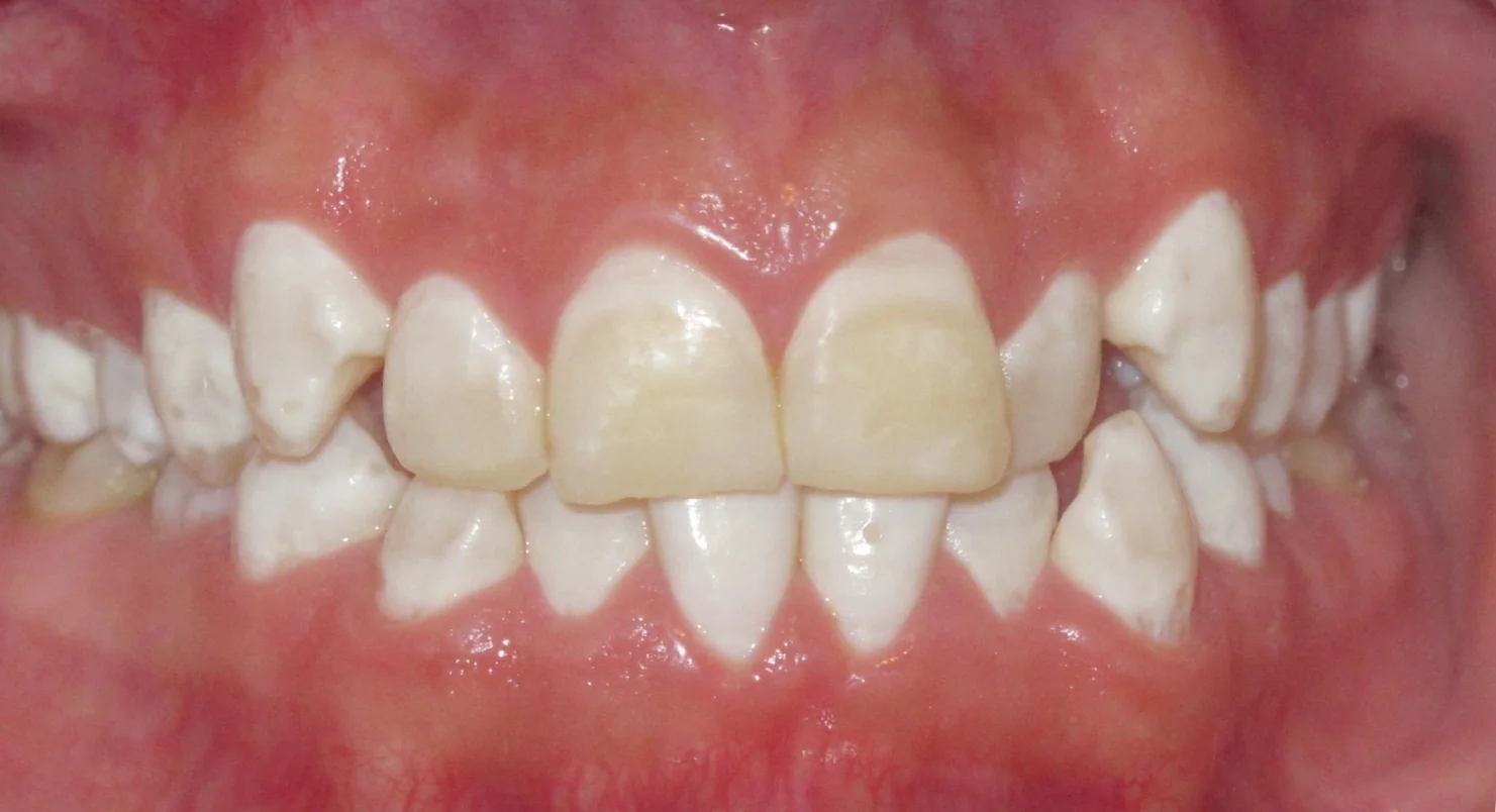 BEFORE: Patient was dissatisfied with the position of teeth and the uneven white spotting (flourosis).