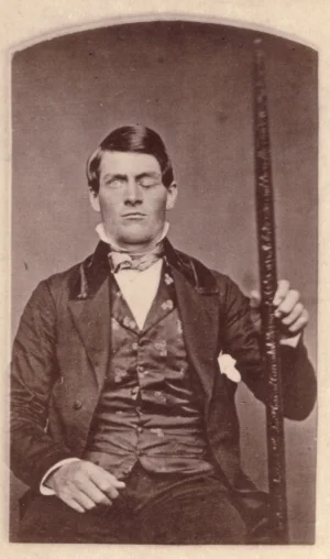 Phineas Gage holding the rod/tamping iron that was blasted through his skull and brain.