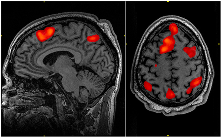 人类大脑的功能磁共振成像