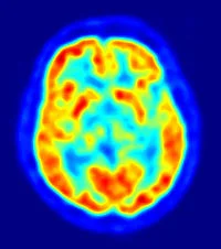 PET scan of the human brain. Image courtesy of Jens Maus.