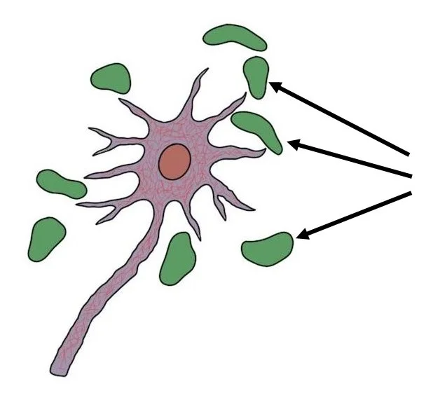 amyloid plaques (in green)