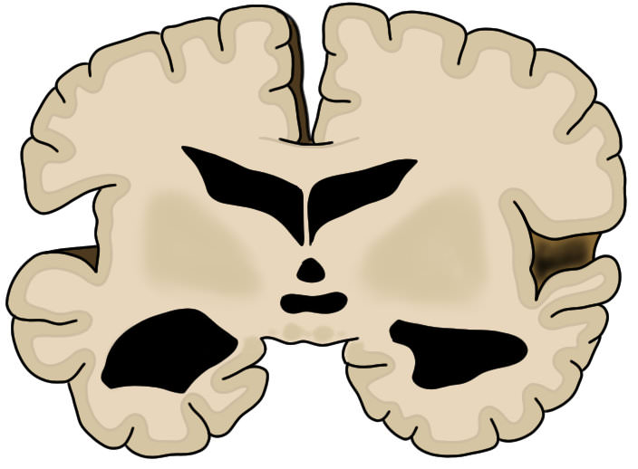 由于阿尔茨海默病的疾病，脑萎缩的冠状细胞萎缩。