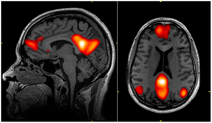 功能磁共振(fMRI)图像显示默认模式网络的活动。