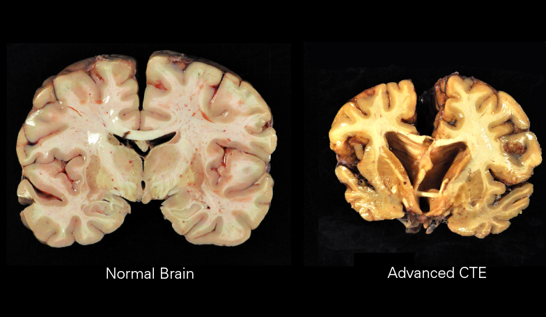 comparison of a healthy brain and brain afflicted with CTE, from the Boston University Center for the Study of Traumatic Encephalopathy