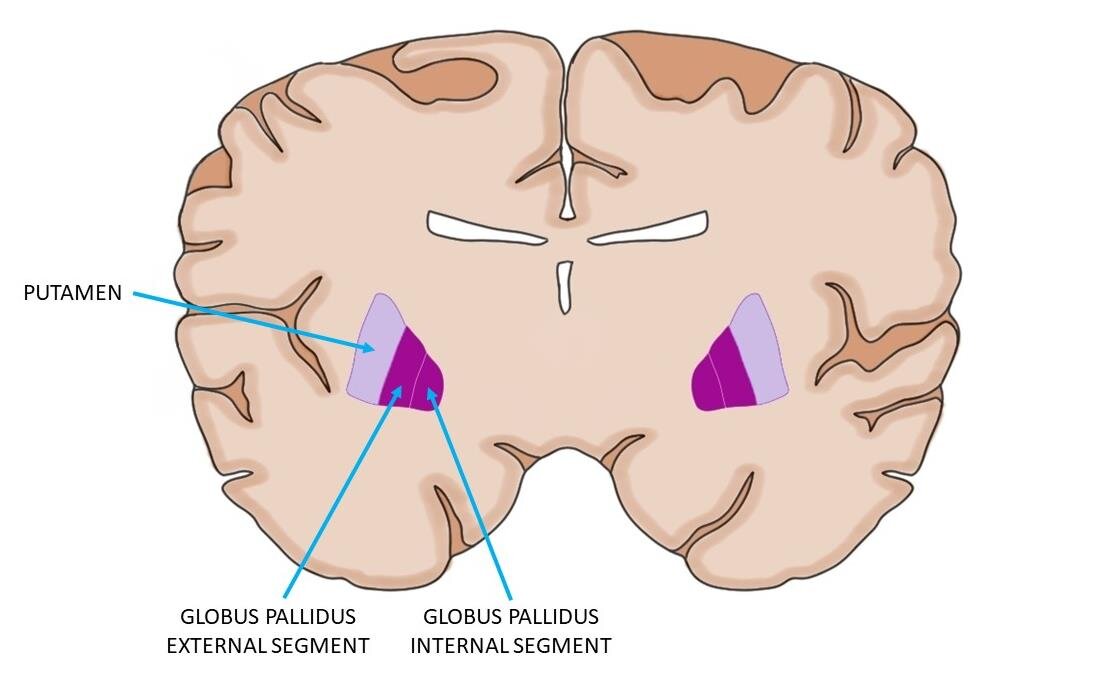 大脑的冠状部分，其显示腐果（浅紫色）和球状苍白（深紫色）的内部和外部段。