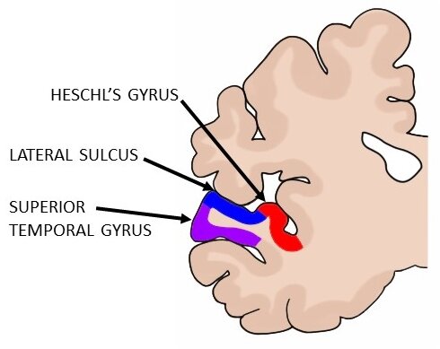 左半球的冠状部分，显示主要听觉皮层（红色）以及周围的听觉区域（蓝色和紫色）​​。