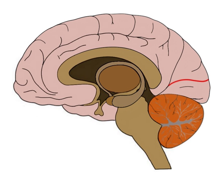 THE CALCARINE SULCUS IS OUTLINED IN RED.