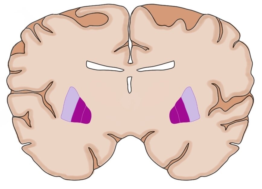 在这种冠状脑部中，Globus pallidus是深紫色的斑点。相邻的浅紫色区域是腐烂。