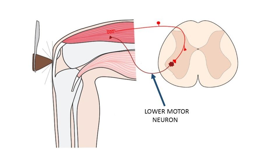 lower motor neuron