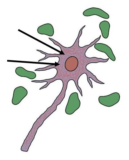 NEUROFIBRILLARY TANGLES ARE REPRESENTED BY THE SMALL RED LINES WITHIN THE NEURON.