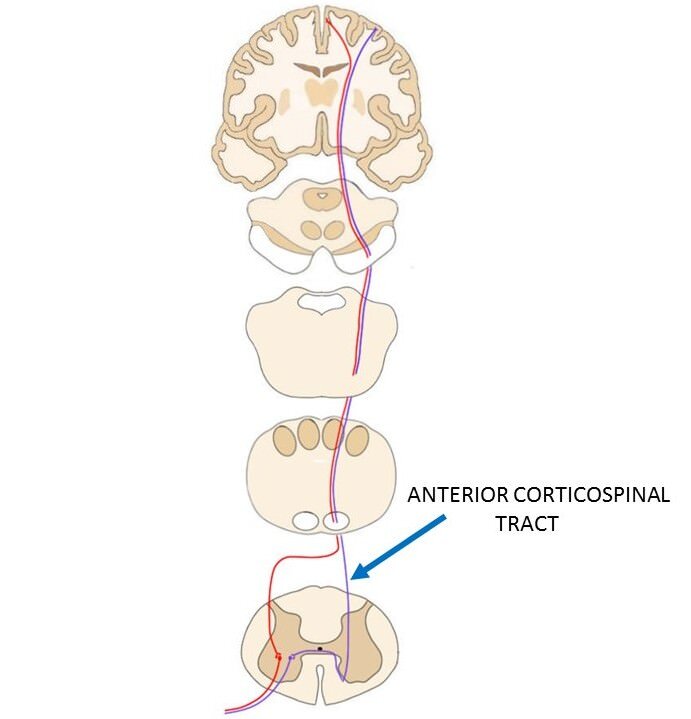 前/腹侧皮质脊髓束由紫色线表示，从运动皮层向下延伸至脊髓。