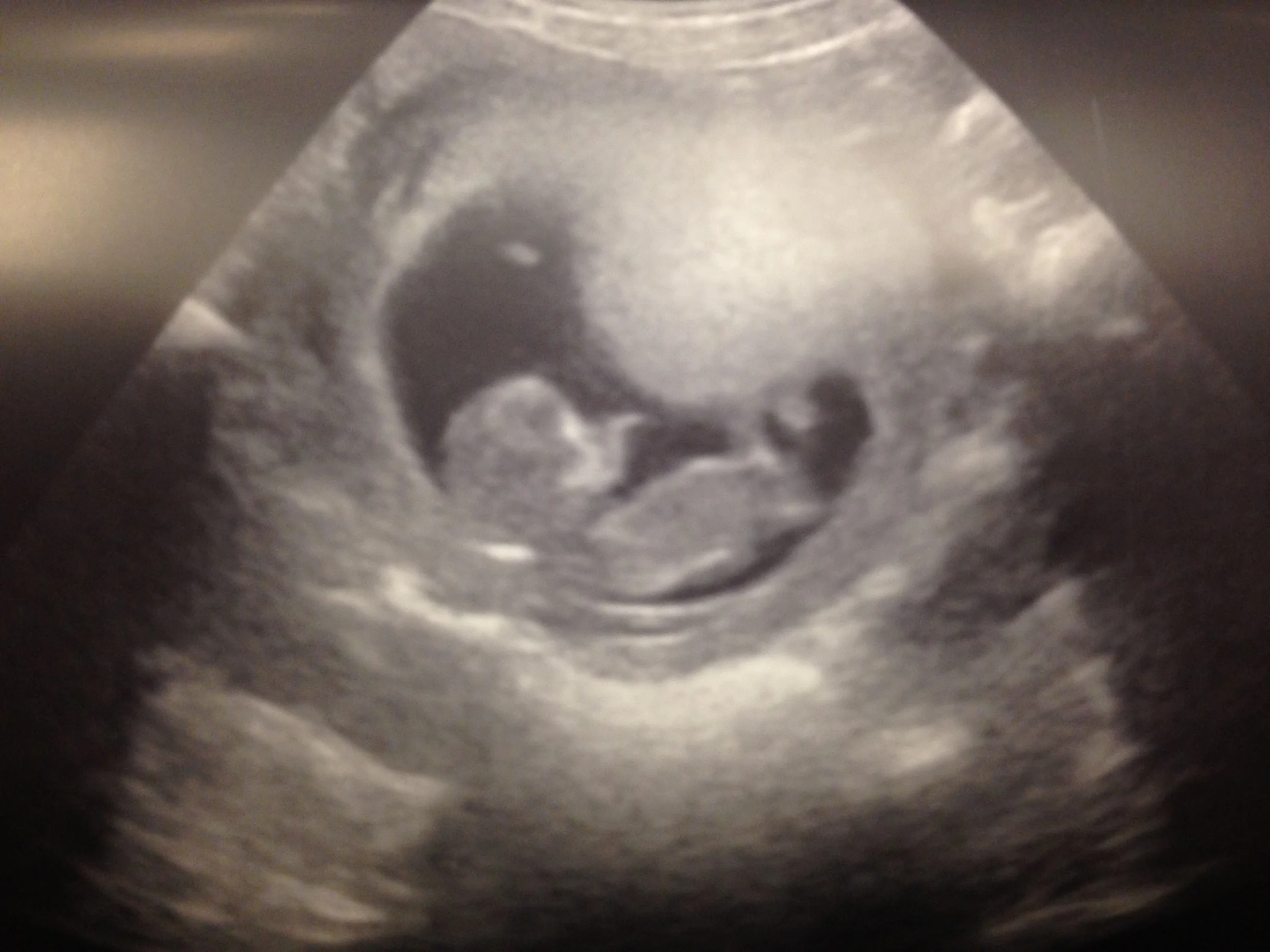 August 20, 2015: 9wks1day - Baby has a heartbeat and the urge to dance apparently.