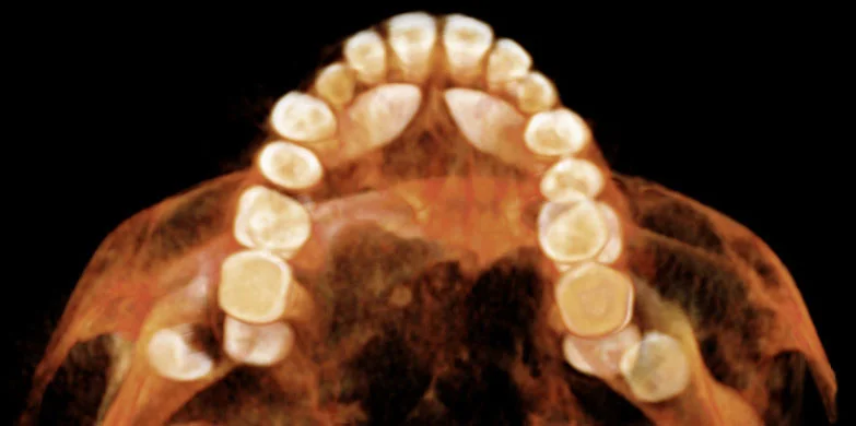 Unerupted Canines to be bonded for Orthodontics