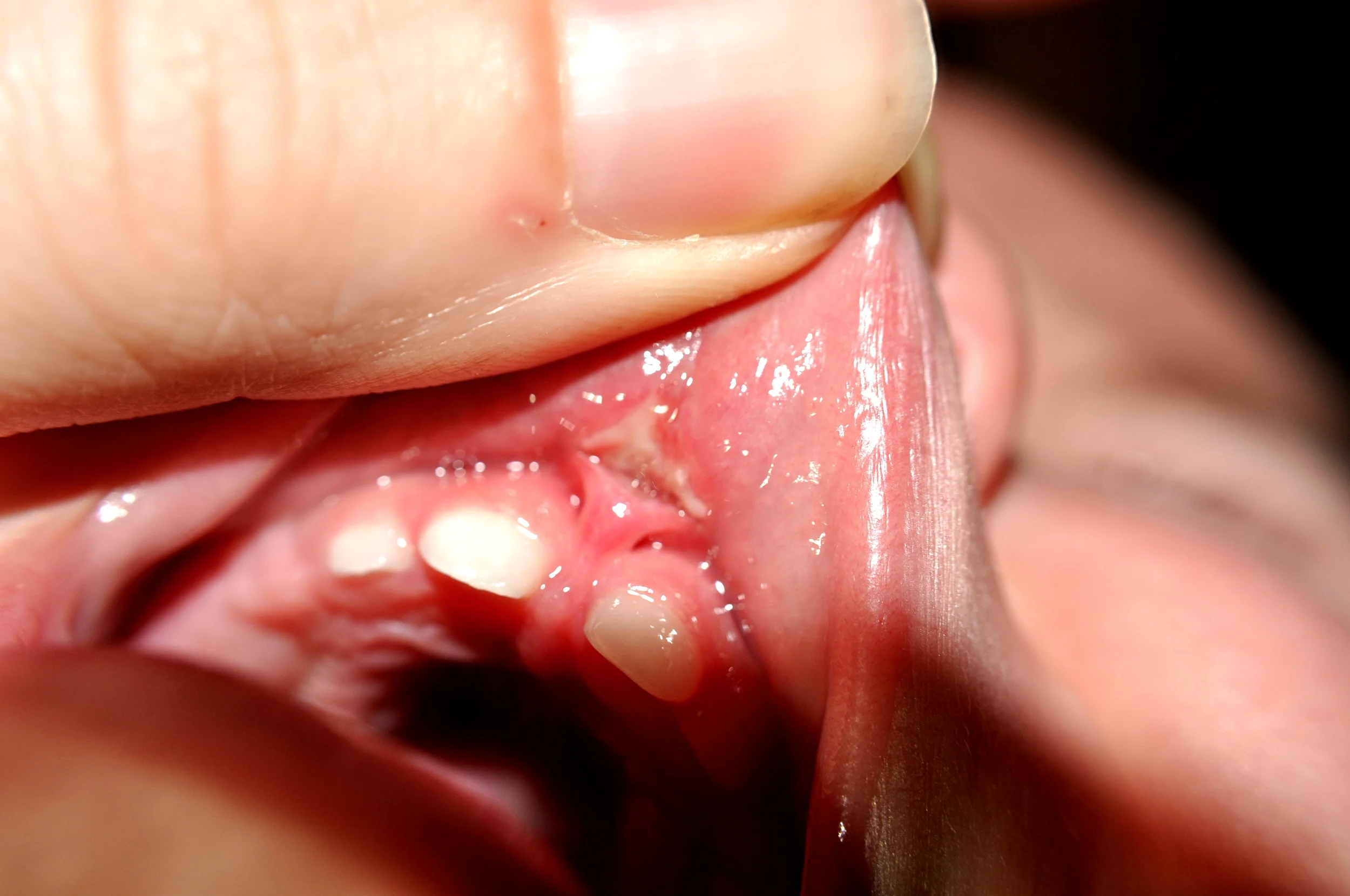 This baby fell and tore his lip tie. See how much tissue is still left down on the gumline? This can predispose the baby to reattachment and can still cause dental issues.