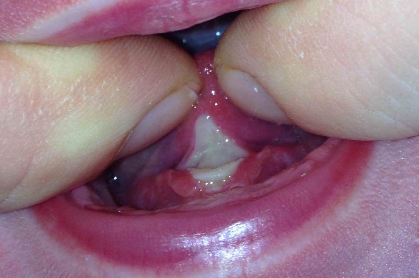 5 days post-procedure