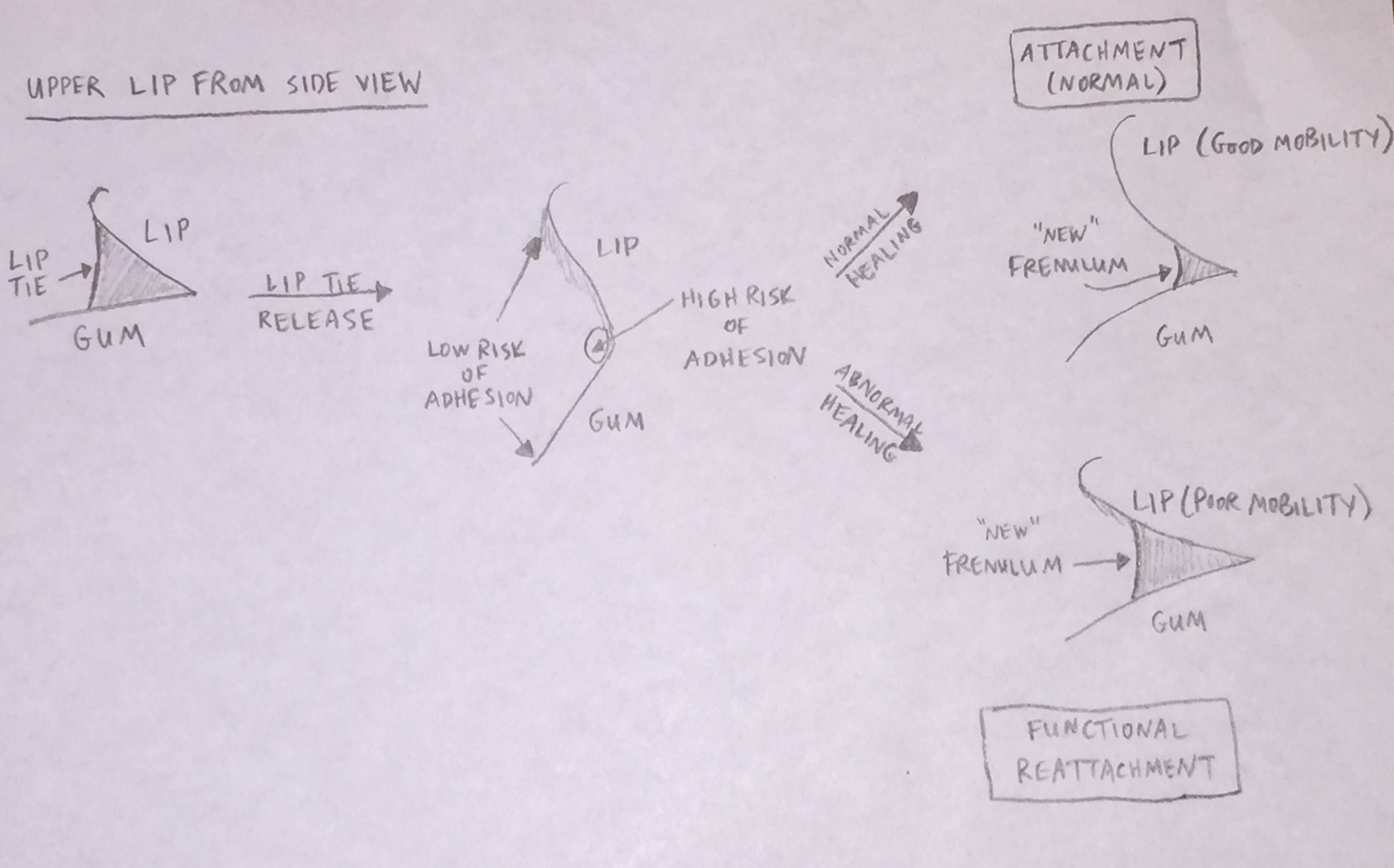 This sketch of the release of a lip tie shows the result of proper wound management, where a finger is gently run under the lip to separate the lip from the gumline, versus poor wound management, where too much of the lip is allowed to readhere to the gumline. Remember, if the initial release was inadequate, then you would never have achieved the good mobility in the first place, so it can mimic the reattached lip.