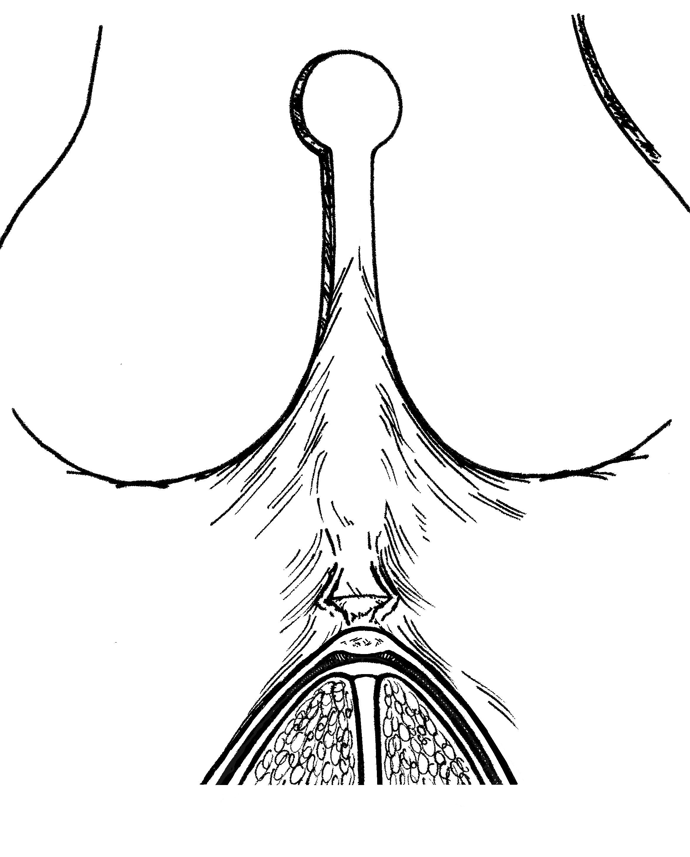 A small window is made through the PTT fibers to begin the release