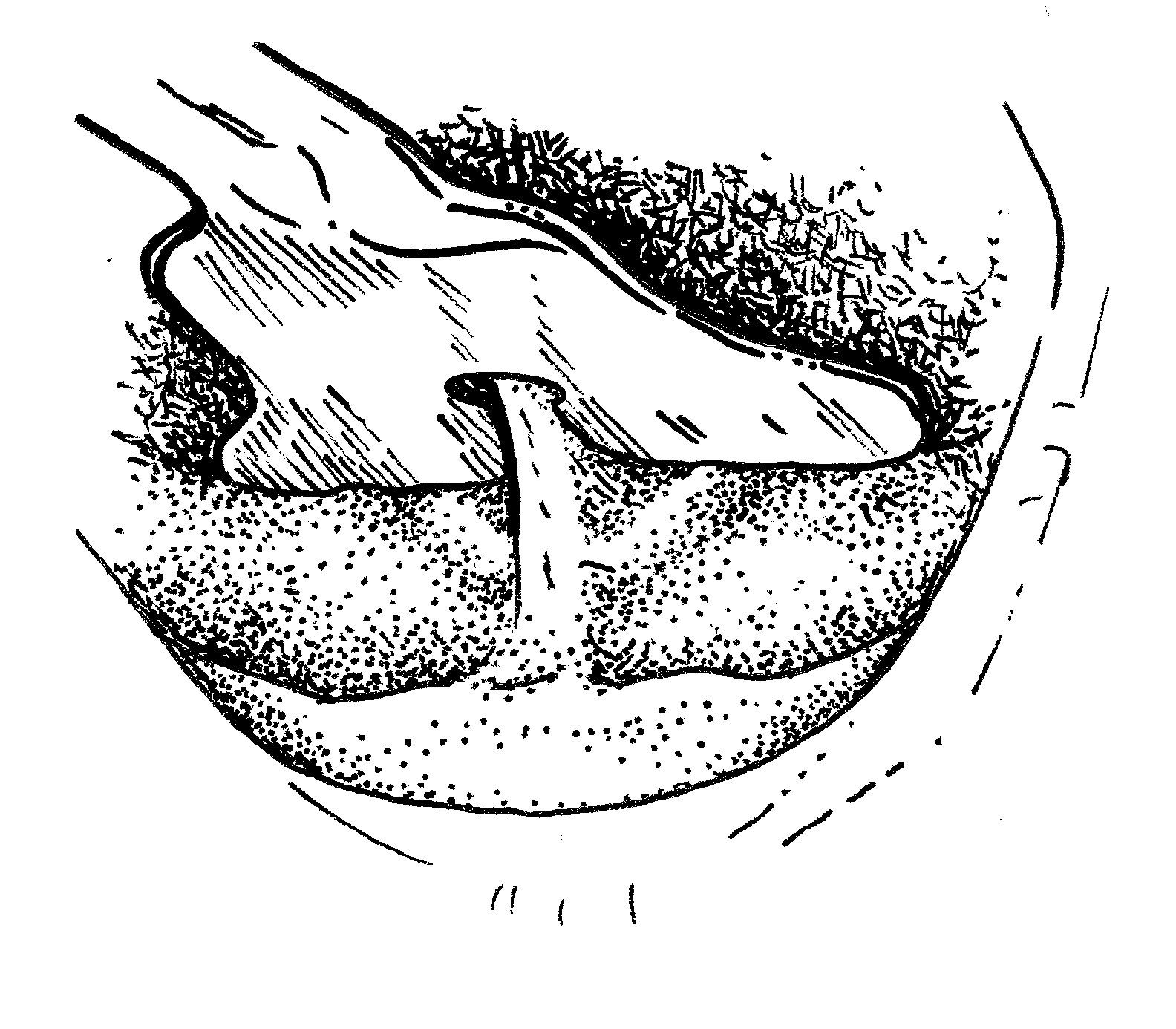 Looking from the top down, the grooved director lifts the tongue out of the way, isolating the posterior tongue tie