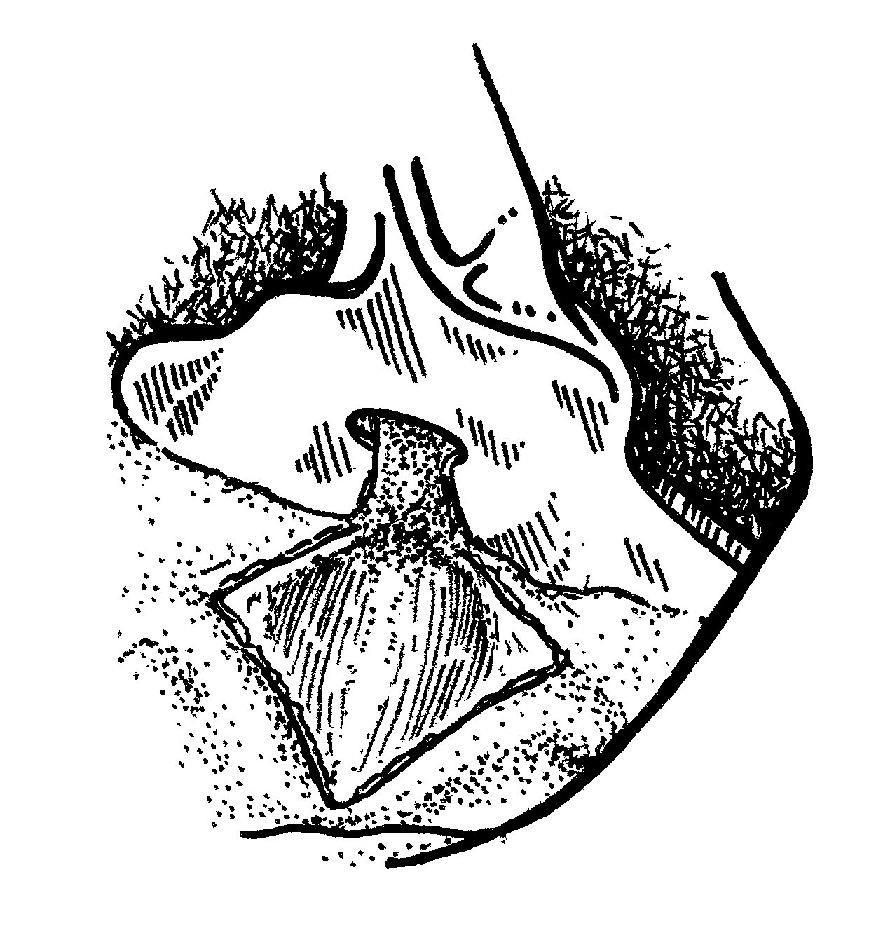 Final diamond-shaped wound is achieved with higher lift with the grooved director