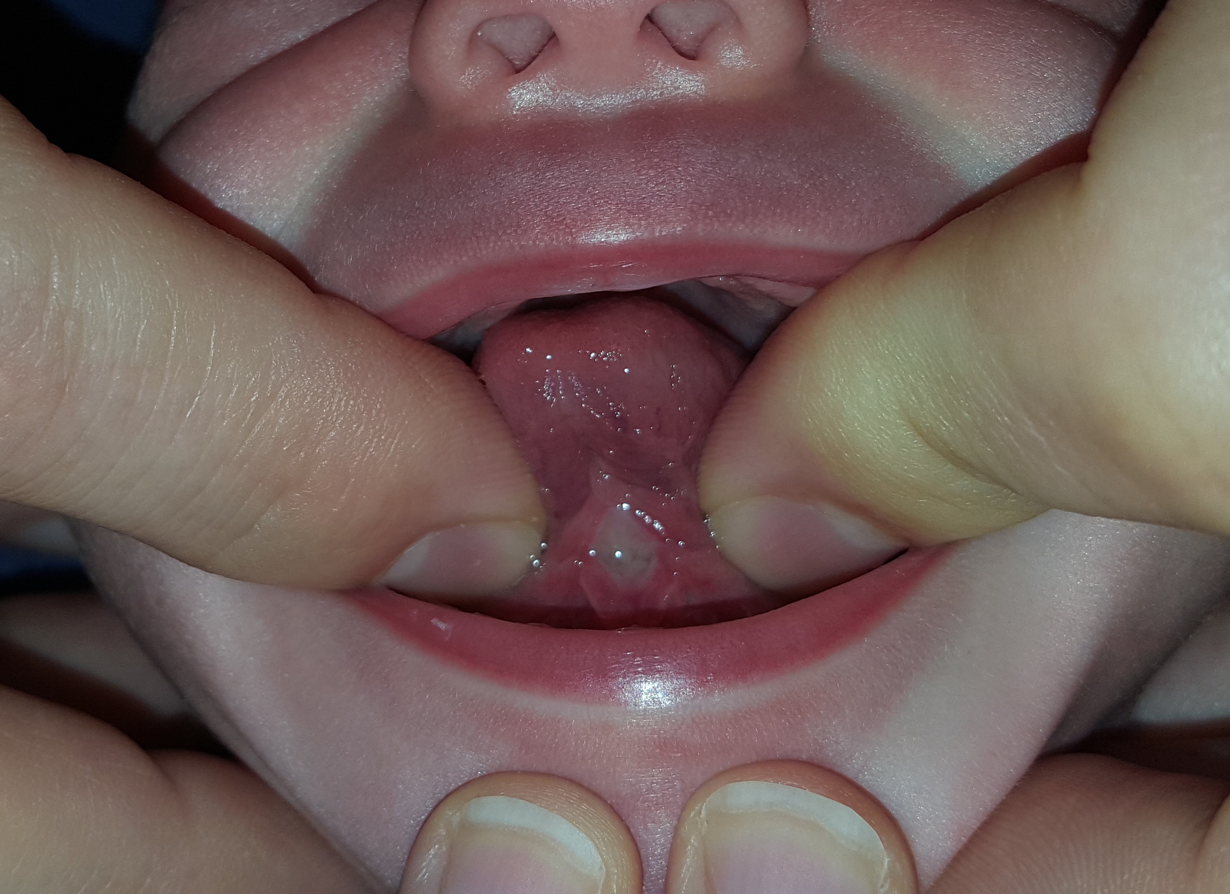 11 days post-procedure