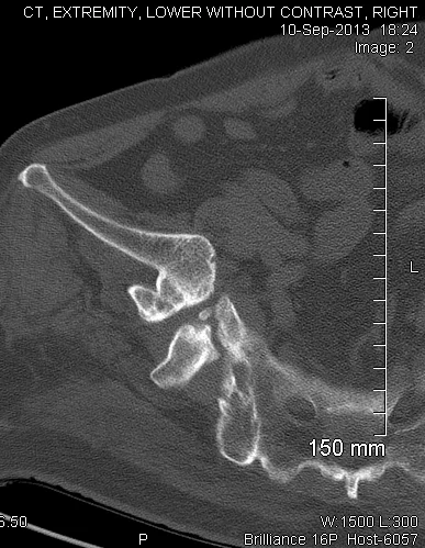 Hip CT scan image