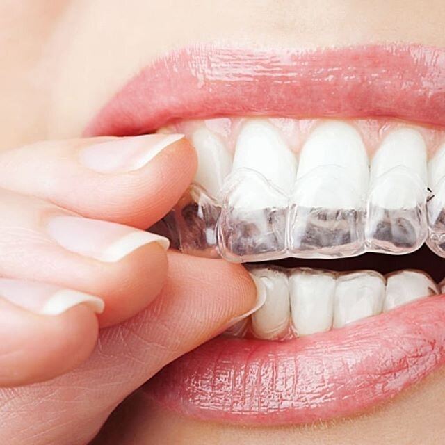 GIVEAWAY TIME!!! Who likes beautiful, white teeth? We are giving away free whitening trays for Valentines Day! ❤A $310 value!  Don't need whiter teeth?  Pass on the gift of free trays to that special someone as a valentines day surprise! 
How to ente