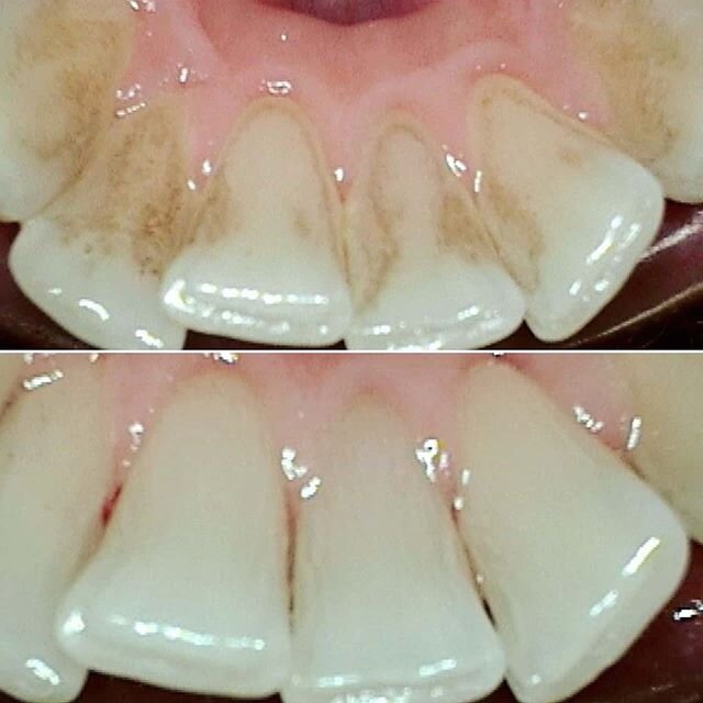This patient presented for a professional cleaning yesterday and asked his hygienist about whitening his teeth. Upon looking in his mouth, it was apparent that he had a moderate amount of stain on the lingual (or inside) portion of his teeth. Likely 