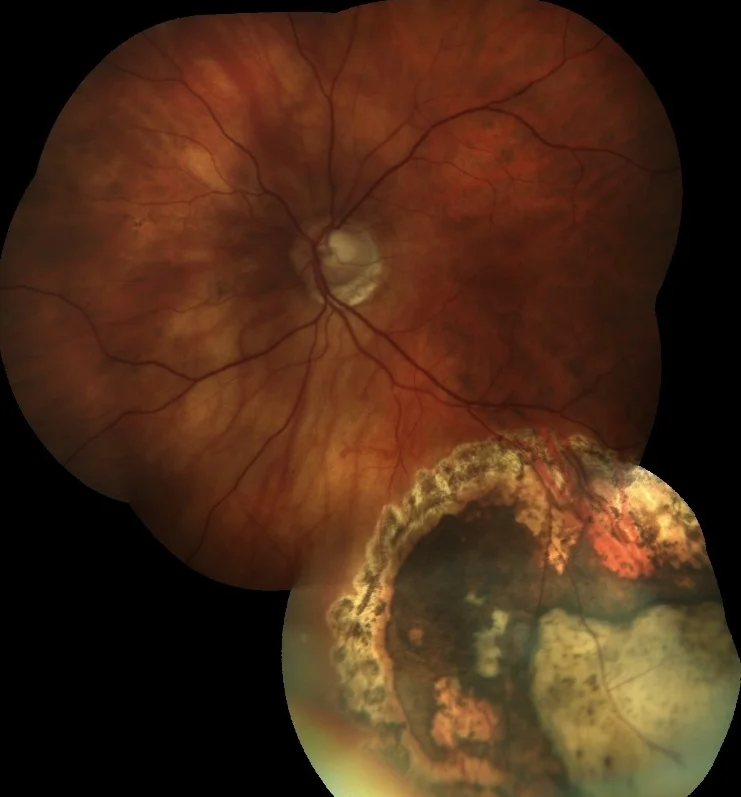 peripheralCNV.jpg
