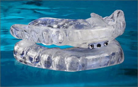 Consensus on Anterior Discluding Stops for OSA Appliances