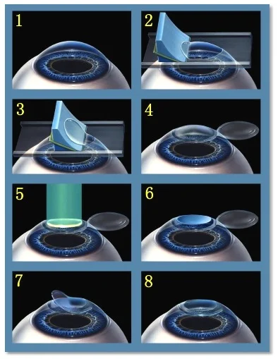 Lasik Steps