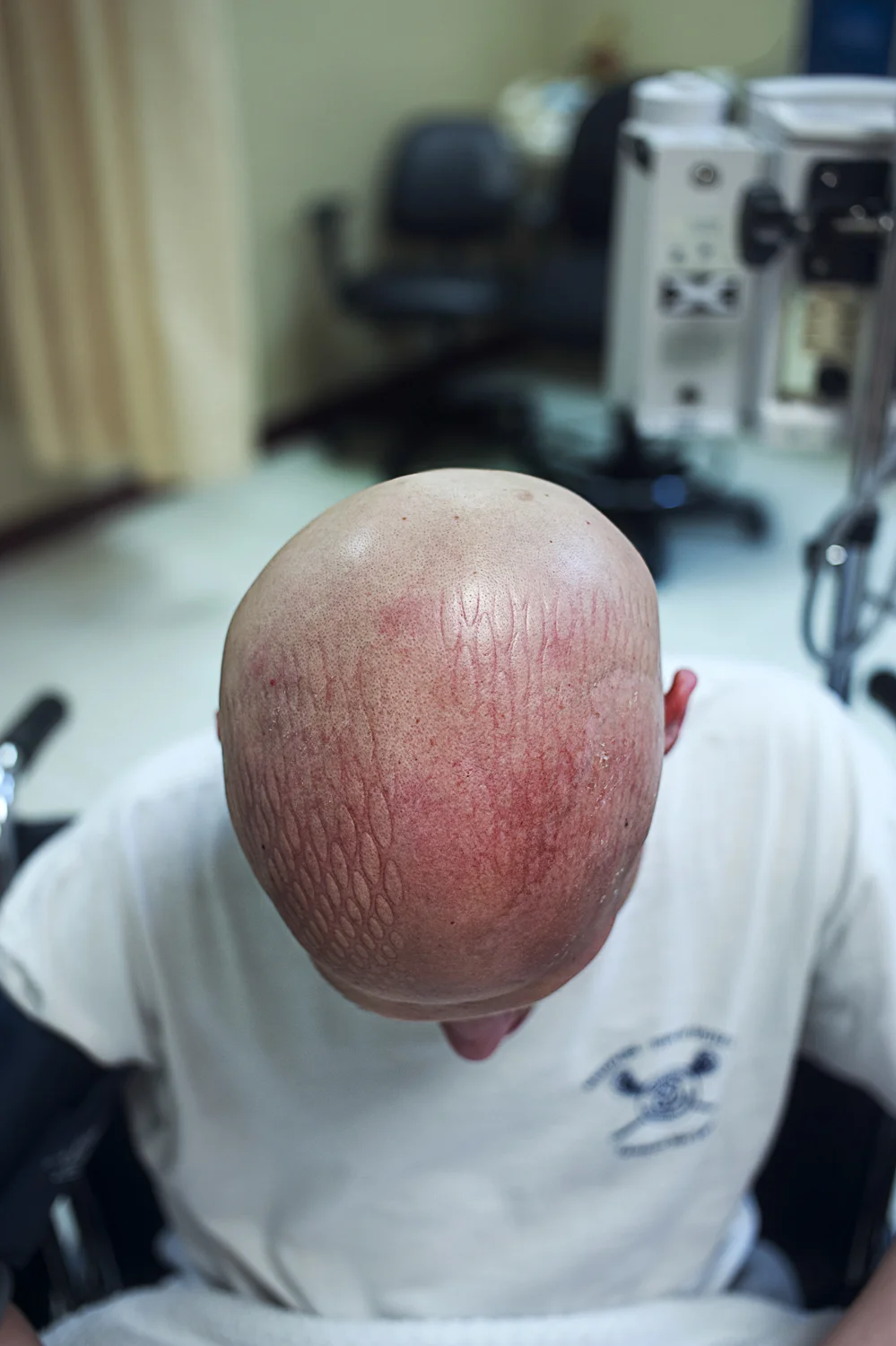  The aftermath of one of&nbsp;Mitch's's radiation treatments leaves indentations&nbsp;from his required mask as heat billows from the radiation treatment itself. &nbsp;He described it as a severe form of sun burning. &nbsp;  Mitch, diagnosed at age&n