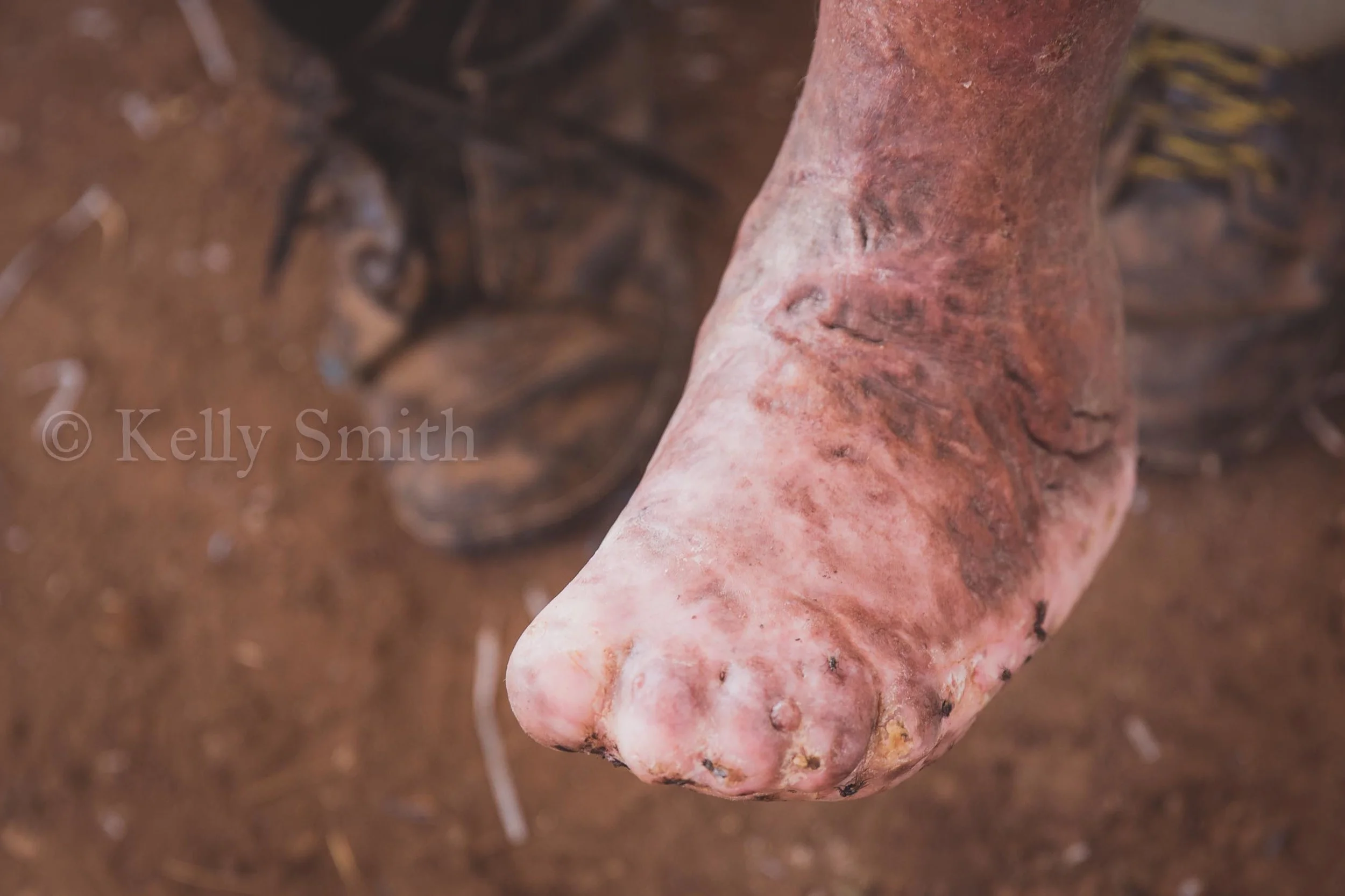 A patient's toes fused together as a result of podo.