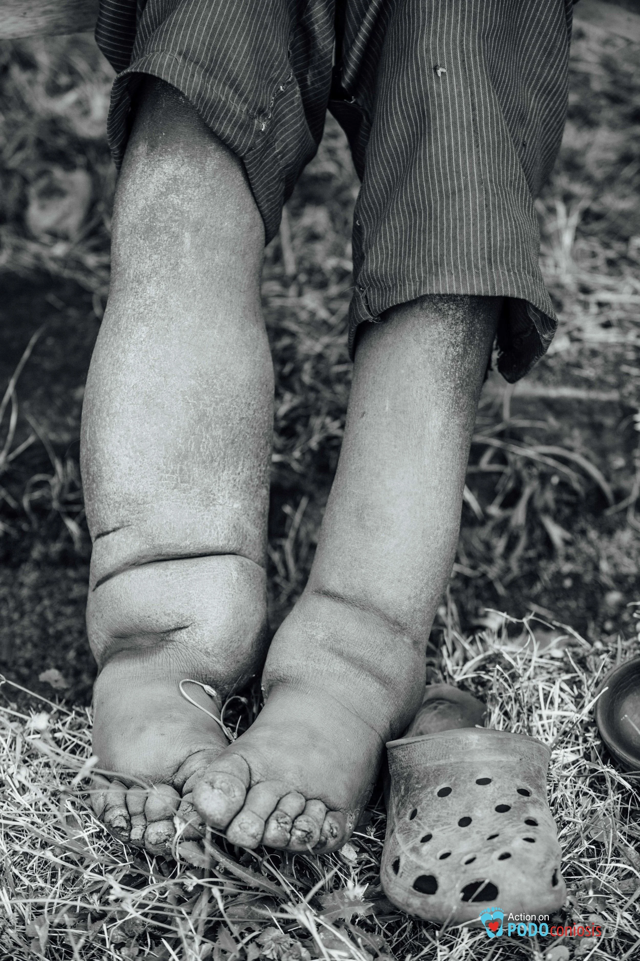 Severe cases of podo like this have devastating effects on whole families.