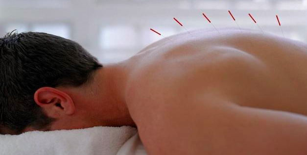 acpuncture.png