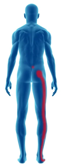 sciatica-piriformis-syndrome.jpg