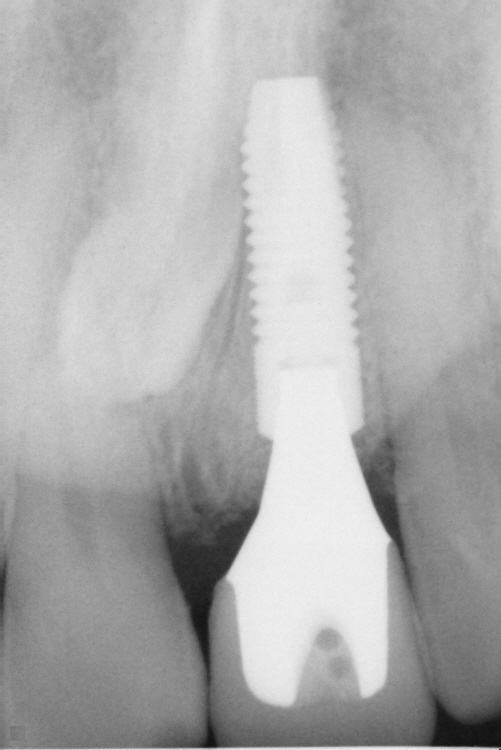 This is the X-ray of the implant, abutment, and all ceramic crown 