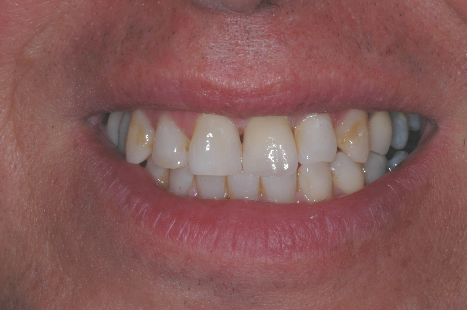  This is the final crown - today's crowns can be very esthetic and indiscernible from the natural teeth.&nbsp; 